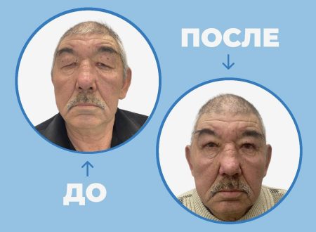 В Астраханской области состоялась успешная операция по коррекции блефарохалязиса